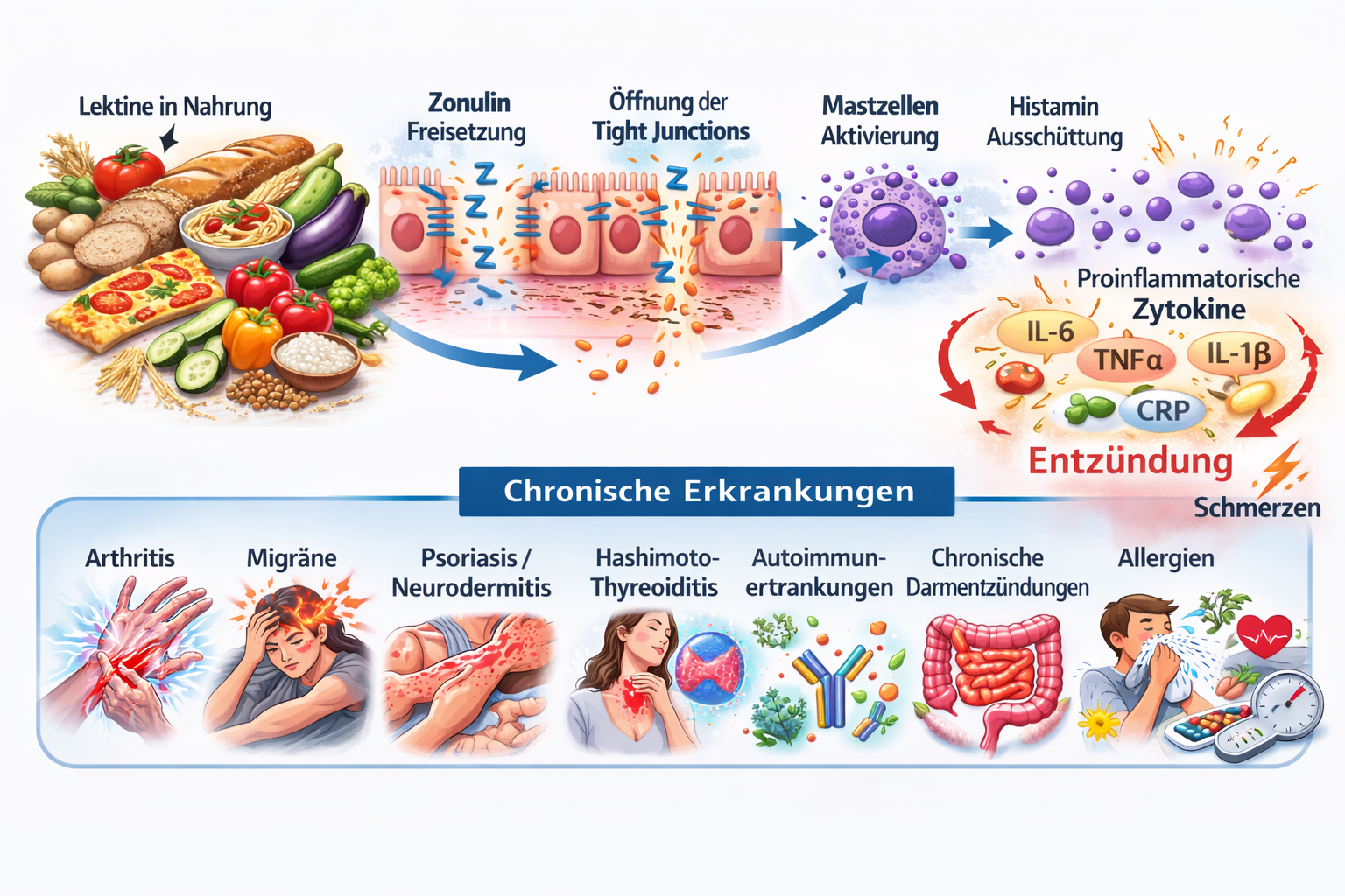 Leaky Gut Ursache Enährung und Auswirkungen auf das Immunsystem und verschiedene Beschwerden